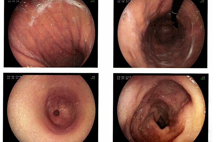 Colonoscopy in Hong Kong: Screening, Government Programmes, and Private Packages